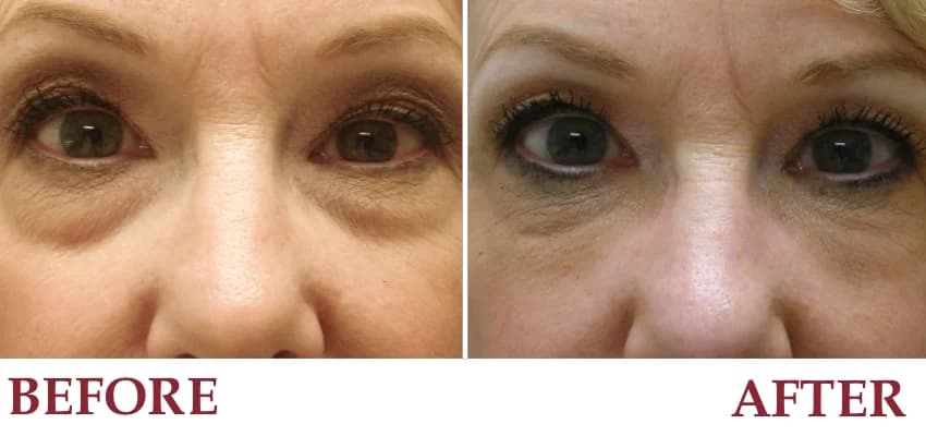 Un-retouched before and after patient photograph — “Bags” under the eyes improved without surgery.