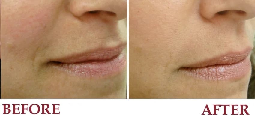 Un-retouched before and after patient photograph — Restylane® used for Nasolabial fold.