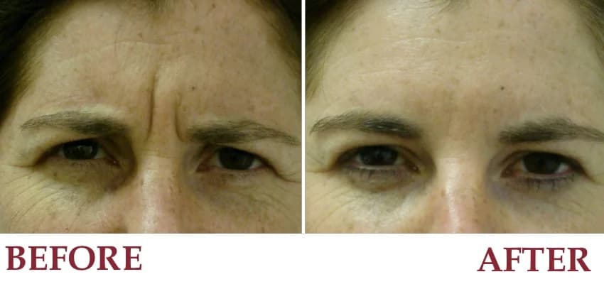 Un-retouched before and after patient photograph — Frown/worry lines disappear with BOTOX® treatment.